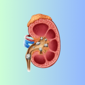 Kidney Stone/ UTI